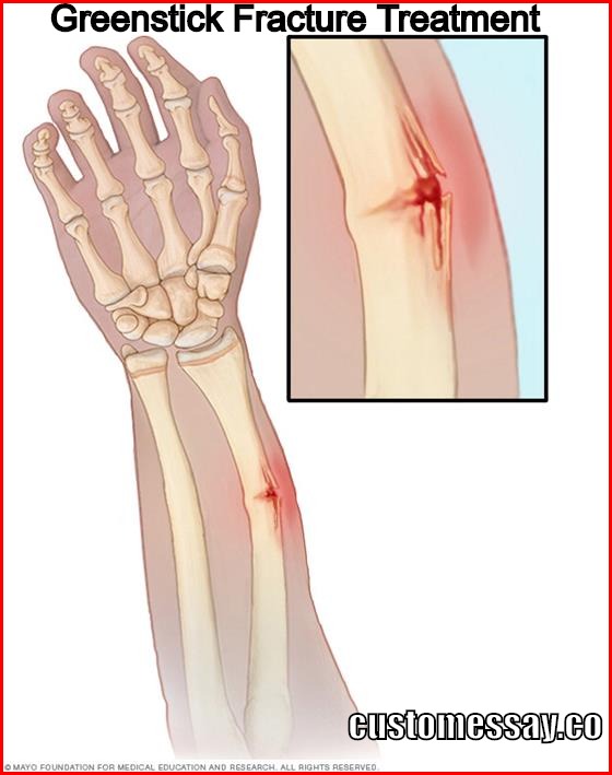 Greenstick Fracture Treatment split femur diagram 